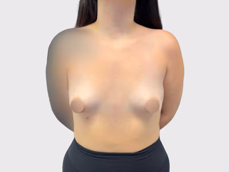 Before - Before and after natural breast enhancement